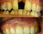 traumatismos-dentales