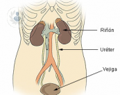 cancer-vejiga