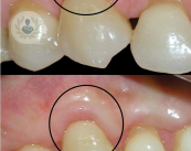 periodontitis-gingivitis