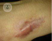 Tratamientos de las cicatrices hipertróficas y los queloides 