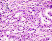 cancer-pancreas-foto