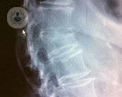 aplastamiento-vertebral