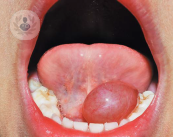 ranula-en-la-parte-sublingual-de-la-boca