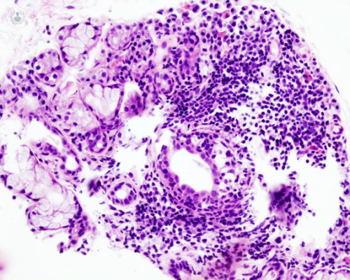 sindrome-sjogren