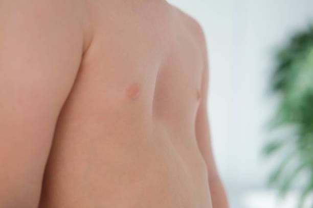 pectus-excavatum-diagnostico-y-tratamiento-opciones-no-quirurgicas-y-quirurgicas imagen de artículo