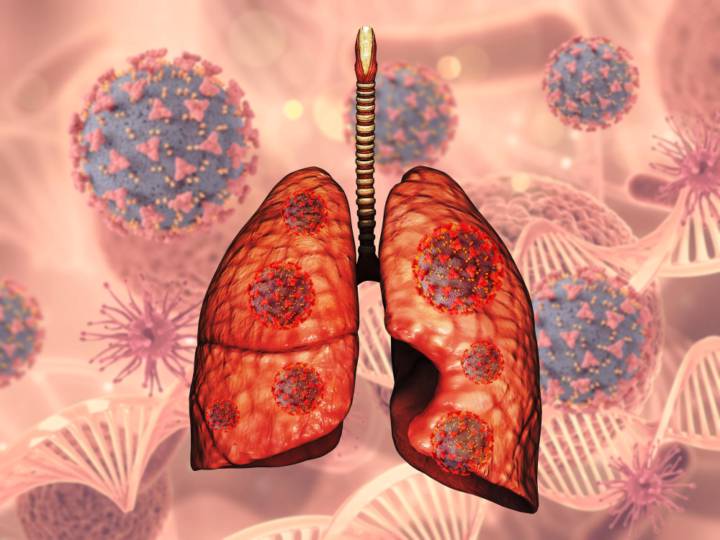 que-es-aspergilosis-broncopulmonar-alergica-como-se-trata imagen de artículo