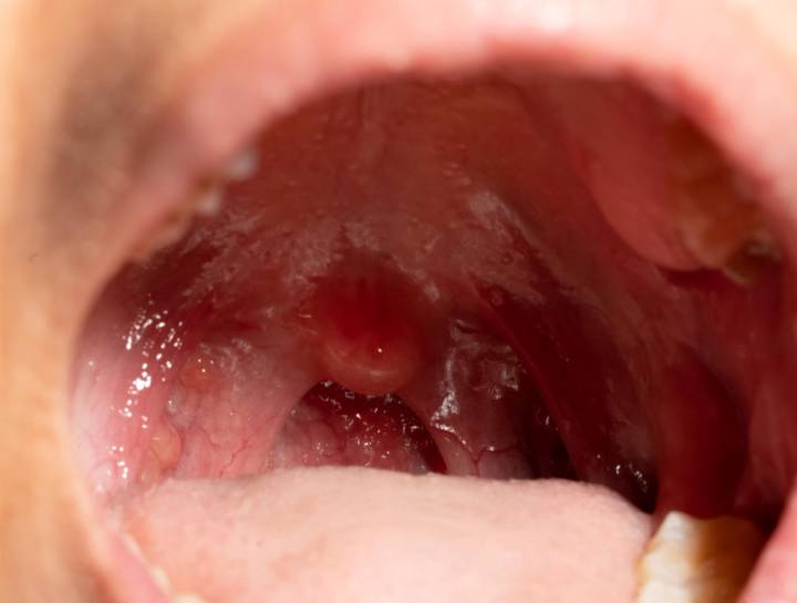 granulomatosis-eosinofilica-poliangeitis-informacion-medica-clara-confiable-pacientes-familias imagen de artículo