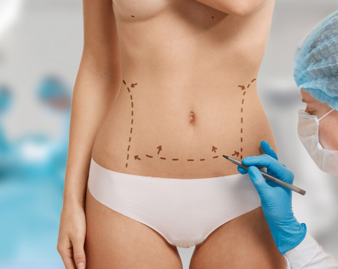 abdominoplastia-que-es-quienes-son-candidatos-y-que-resultados-esperar imagen de artículo