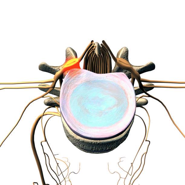 estenosis-de-canal-lumbar-neurocirugia imagen de artículo