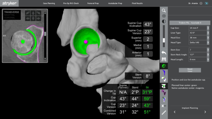reemplazo-cadera-robotico-precision-submilimetrica imagen de artículo