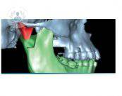 dolencias-en-la-articulacion-de-la-mandibula