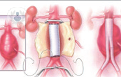 aneurisma-de-aorta-foto