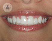 Maloclusión dentaria y su solución con Ortodoncia