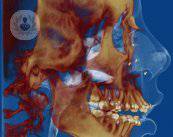 Tratamiento multidisciplinar: Ortodoncia y Cirugía Ortognática