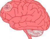 neurocirugia-via-nasal