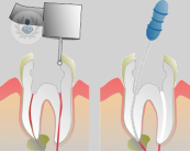 tratamiento-endodoncia