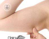 laserlipolisis-grasa