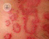 placas-de-psoriasis