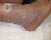 dermatitis-de-estasis