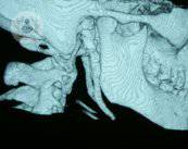 sindrome-de-eagle-caso-dr-maiz