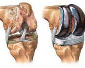 asi-se-realiza-una-protesis-de-rodilla