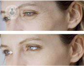 tratamiento-mesoterapia-facial