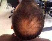 alopecia
