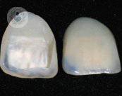 carillas-dentales-para-sonrisa-perfecta