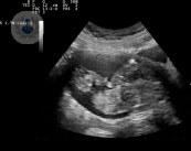 aborto-espontaneo