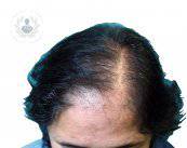 La alopecia femenina también se puede tratar