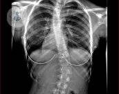 escoliosis