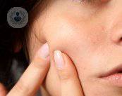 El acné no está causado por la ingesta de ciertos alimentos