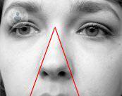sinusitis1