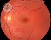degeneracion-macular-asociada-a-la-edad