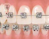 Diferencias entre ortodoncia lingual, tradicional e invisible