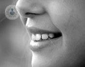 sonrisa-perfecta-con-la-tecnica-all-on-four