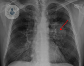 radiografia-pulmones