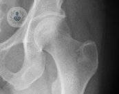 como-identificar-la-artrosis-de-cadera