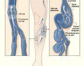 varices