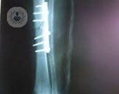 osteosintesis-minimamente-invasiva