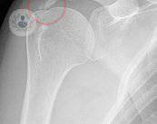radiografia-de-hombro
