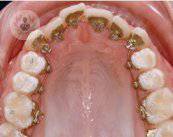 ortodoncia-interior