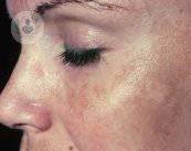 Causas y tratamientos del melasma (“manchas faciales”)