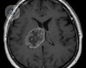 Glioblastoma multiforme, el tumor cerebral más maligno