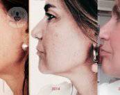 tipos-hilos-tensores