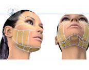 ultherapy