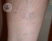 escleroterapia-piernas