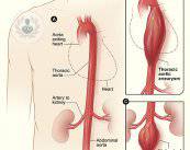 dibujo-aneurisma-de-aorta
