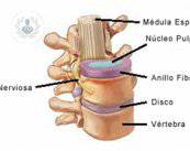 lumbalgia