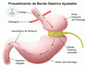banda-gastrica-la-mejor-opcion-para-una-reduccion-de-estomago